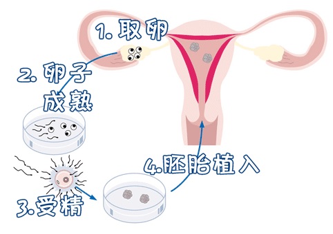 试管婴儿供卵代生咨询